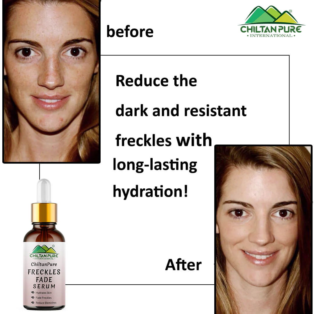 Freckles Fade Serum – Hydrates Skin, Fade Freckles, Reduce Blemishes & Lighten Pigmentation - Image 4